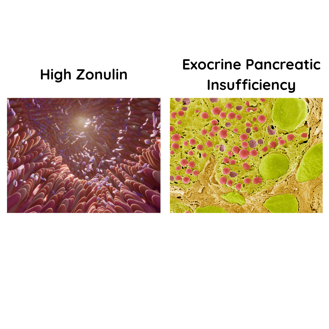 Fecal Bile Acids and Microbial Amino Acid Metabolites in Serum are Correlated with Fecal Zonulin in Dogs with Exocrine Pancreatic Insufficiency ECVIM